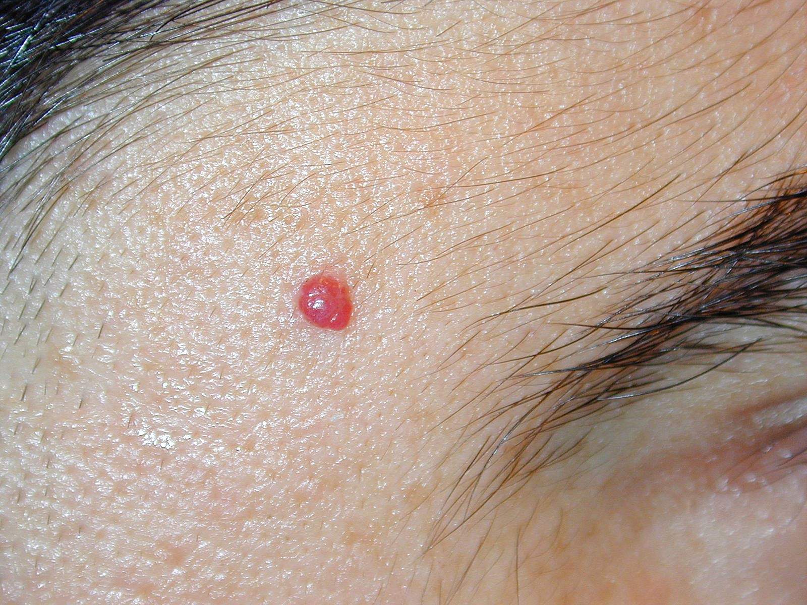 Are Venous Angiomas Benign Spinal Hemangioma What It Is Causes 